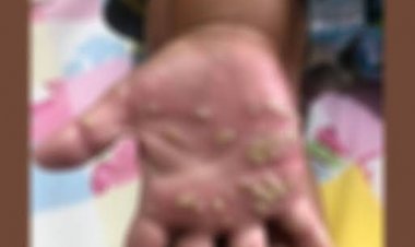 คนมีลูกเล็กระวัง! เด็กๆเล่นดิน ทราย พงหญ้า ทำติดเชื้อตุ่มหนองขึ้นได้