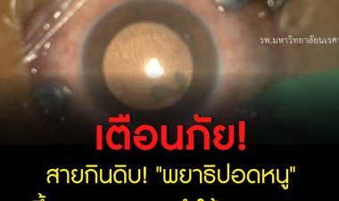 เตือนภัยสายกินดิบ! "พยาธิปอดหนู" ขึ้นตารุนแรงจนทำให้ "ตาบอด"