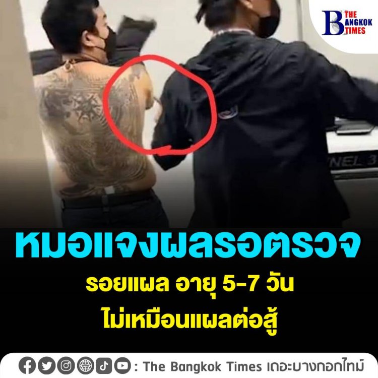 หมอแจงผลตรวจรอยแผล จ๊อบ นิทัศน์ อายุ 5-7 วัน ไม่เหมือนแผลต่อสู้