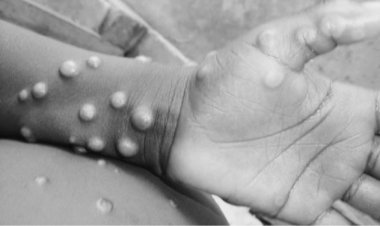 WHO ยันพบผู้ป่วยฝีดาษลิง 80 รายใน 11 ประเทศ