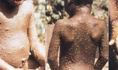 ผวากันทั้งเมือง!ผู้ป่วยฝีดาษลิงรายแรกในไทยหนีออกจากรพ.ภูเก็ต