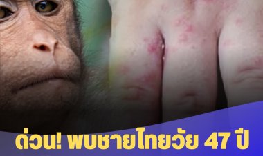 ด่วน! พบชายไทยวัย 47 ปี ติดเชื้อโรค ฝีดาษลิง ในกทม.