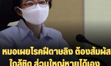หมอเผยโรคฝีดาษลิง ต้องสัมผัสใกล้ชิด ส่วนใหญ่หายได้เอง ใน 4 สัปดาห์ รักษาตามอาการ