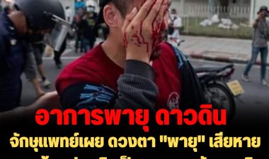 จักษุแพทย์เผย ดวงตา "พายุ" เสียหายมาก ต้องประเมินเป็นระยะ -ระวังการติดเชื้อขั้นสูง เจ้าตัวมีไข้สูง