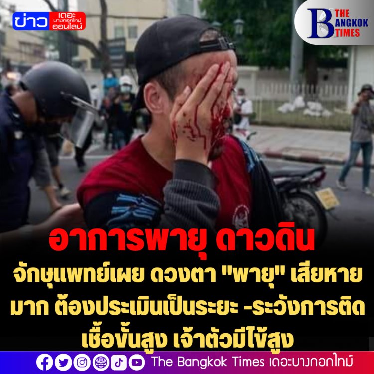 จักษุแพทย์เผย ดวงตา "พายุ" เสียหายมาก ต้องประเมินเป็นระยะ -ระวังการติดเชื้อขั้นสูง เจ้าตัวมีไข้สูง